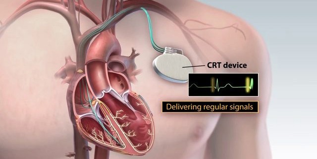 Medmovie.com | Cardiac Resynchronization Therapy Device Feature