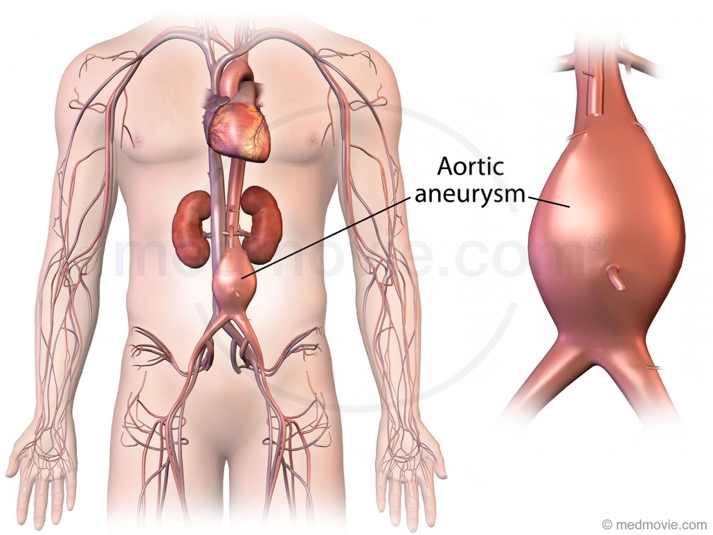 Aortic Aneurysm Surgery Medmovie Com