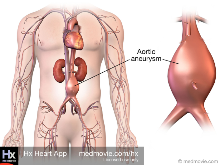 Aortic Aneurysm