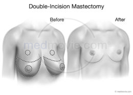 Double-Incision Mastectomy