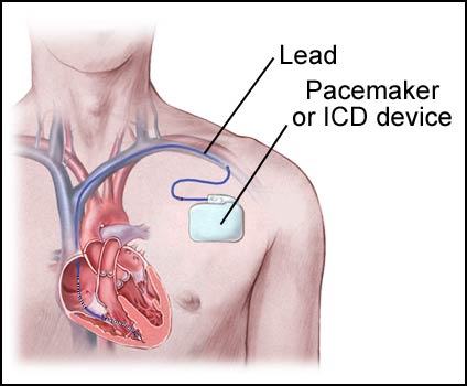 Active Fixation Lead