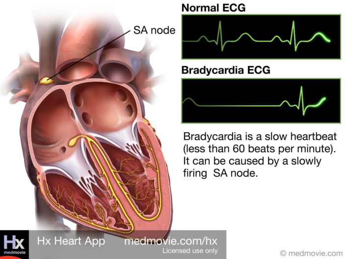 Bradycardia