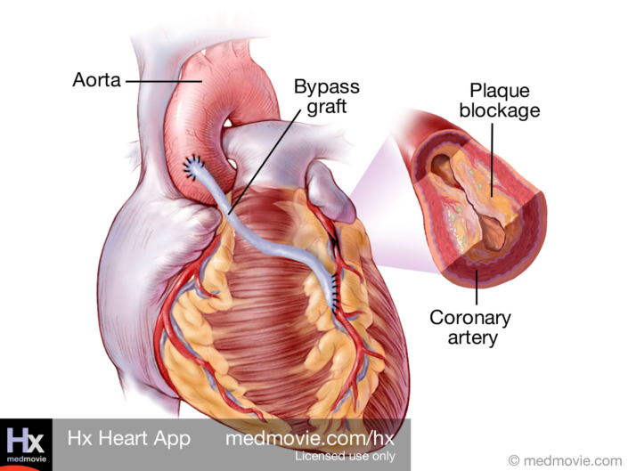Coronary Artery Bypass Graft