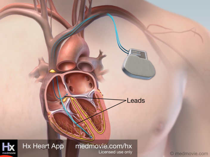 Leads