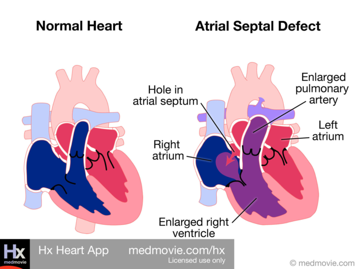 Atrial Septal Defect