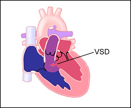 Ventricular Septal Defect