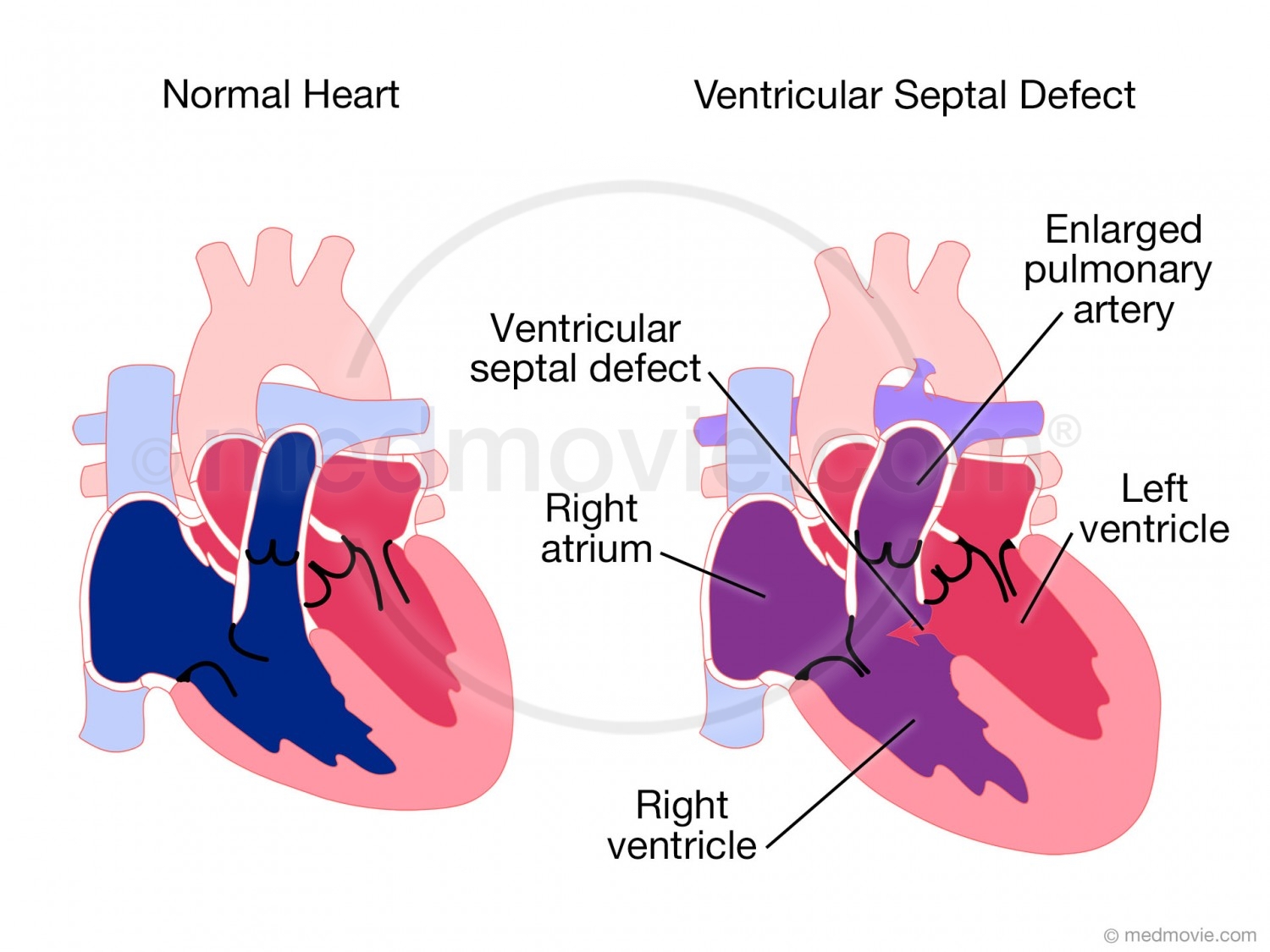 Ventricular Septal Defect