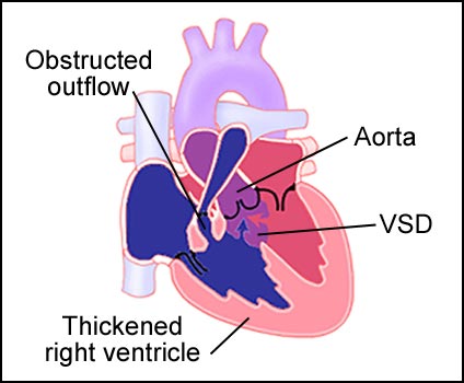 Tetrology of Fallot