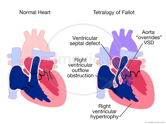 Ventricular Septal Defect