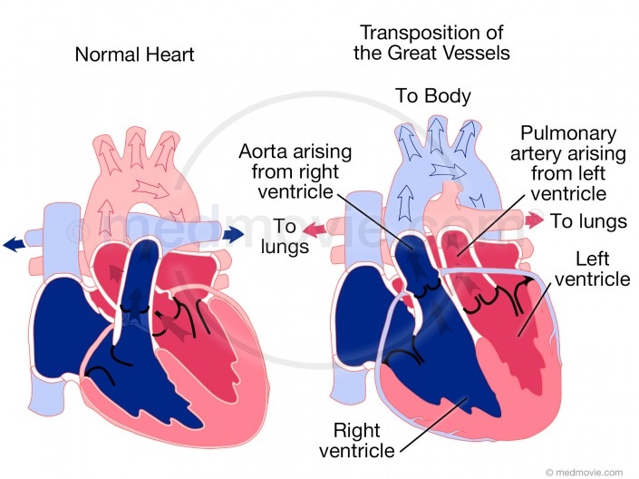 Tricuspid Atresia