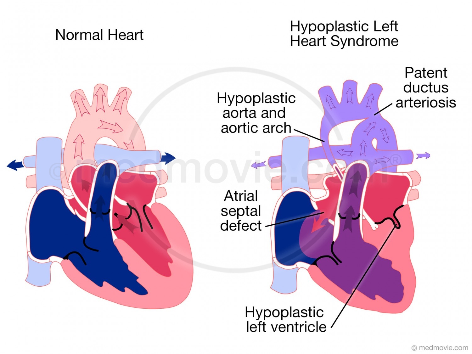 Hypoplastic Left Heart Syndrome 5891