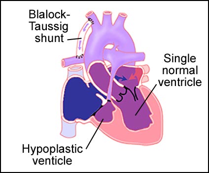 Single Ventricle