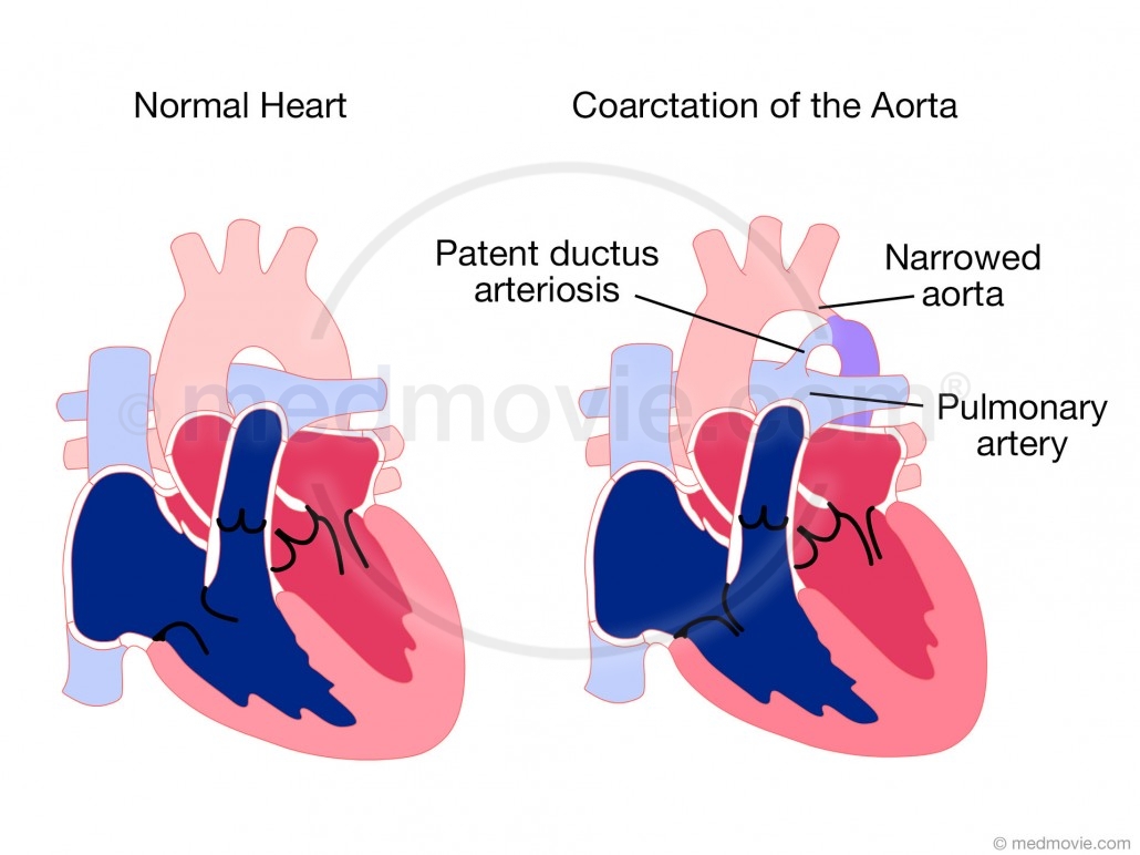 Coarctation of the Aorta