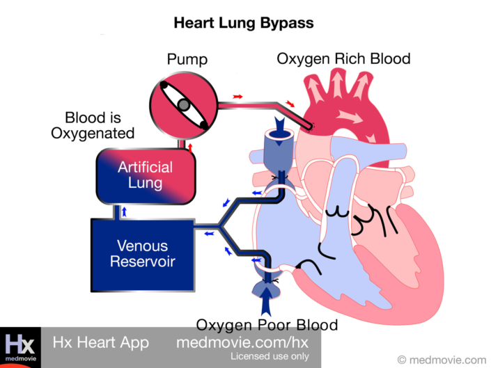 Heart Lung Bypass