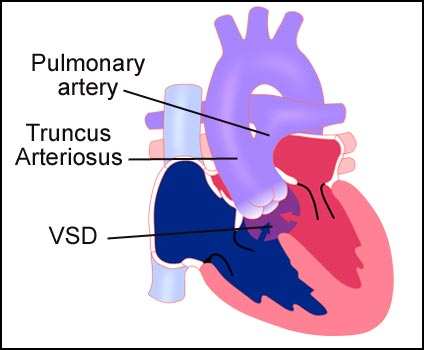 Truncus Arteriosis