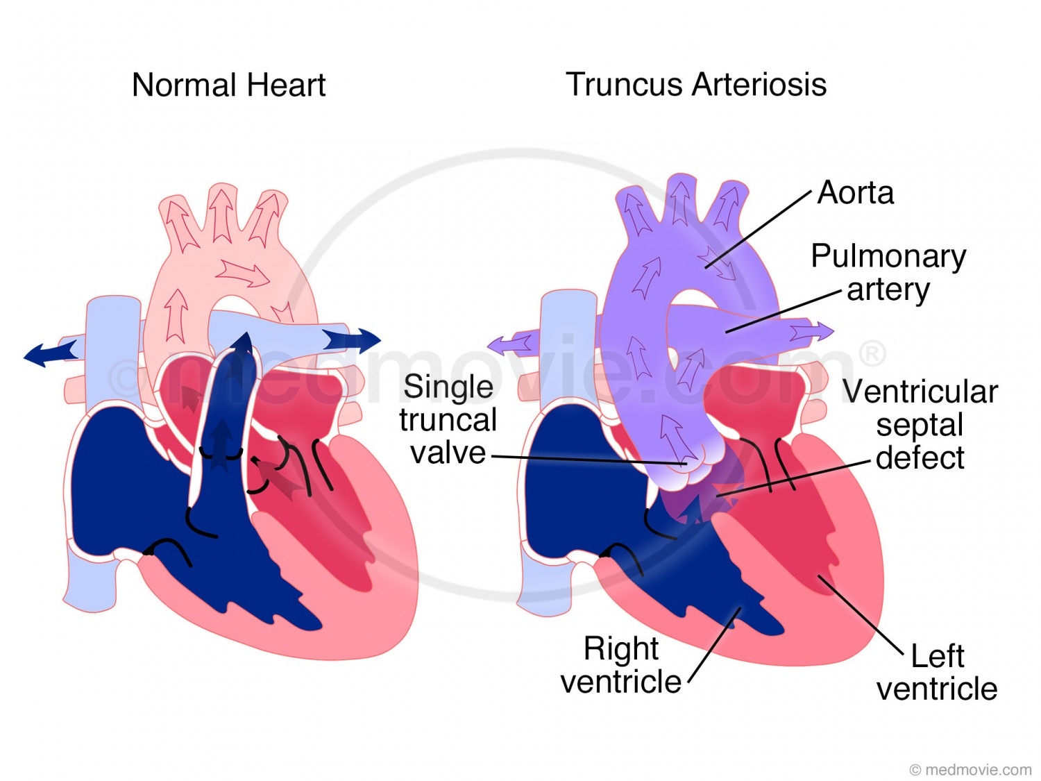 Truncus Arteriosis