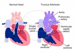 Truncus Arteriosis