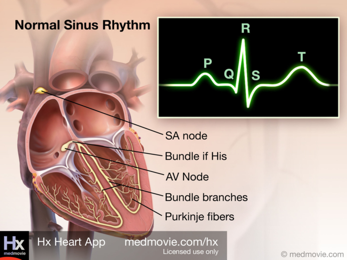 Normal Sinus Rhythm