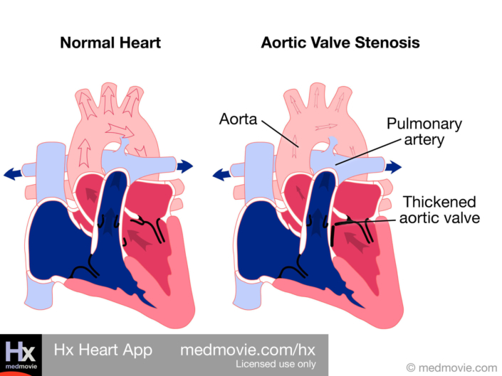 Aortic Valve Stenosis