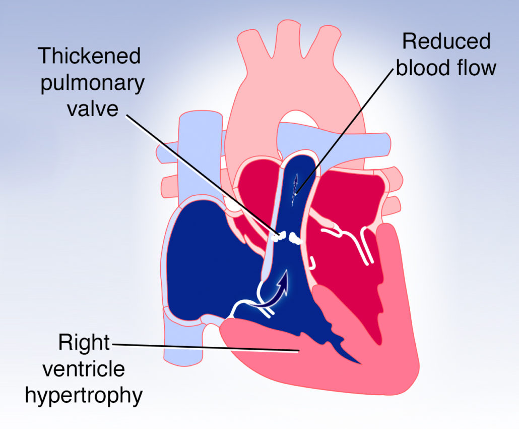 Pulmonary Valve Stenosis