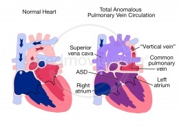 Total Anomalous Pulmonary Vein Circulation (TAPVC)