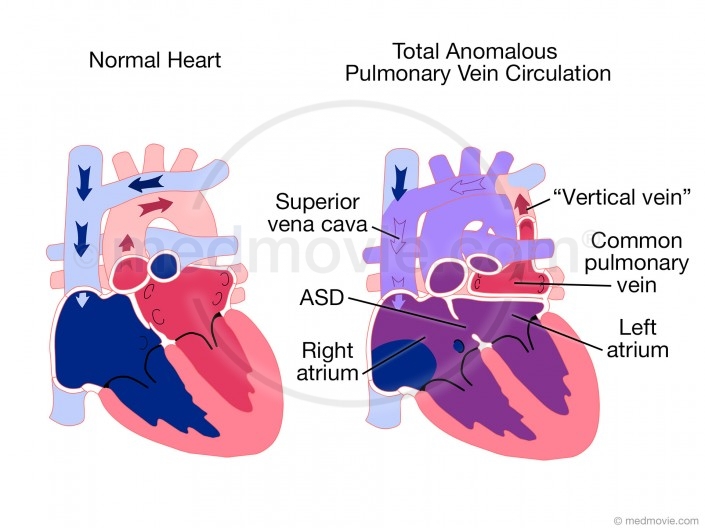 Total Anomalous Pulmonary Venous Circulation (TAPVC)