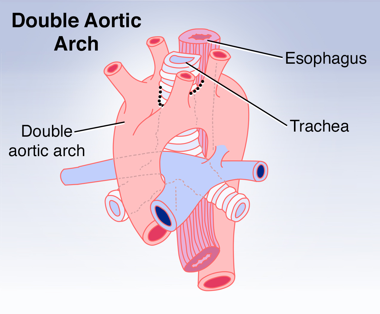 Aortic Arch Developmental Defects