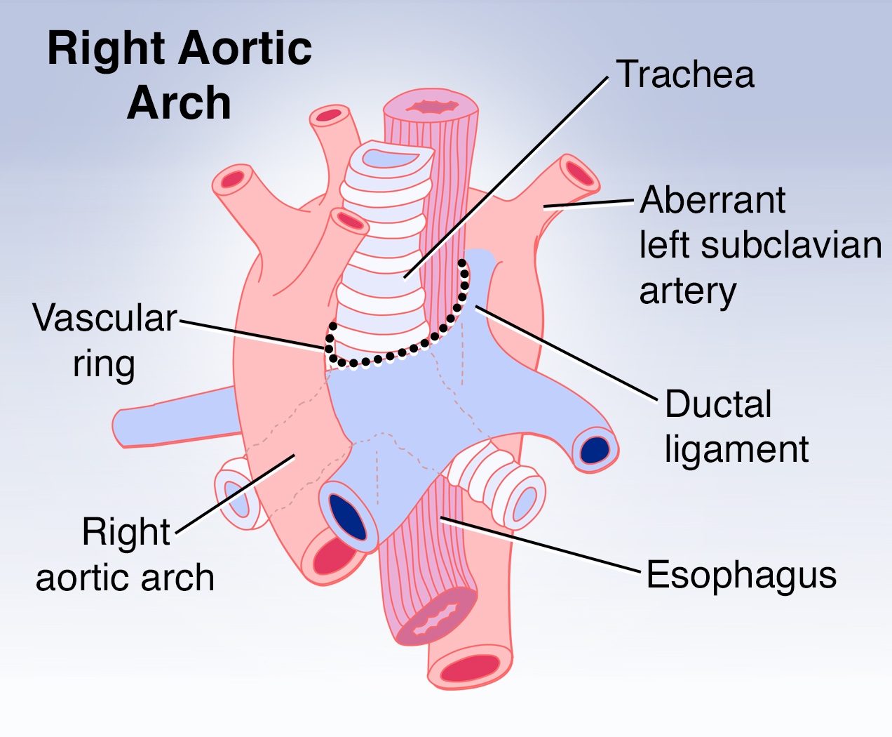 interrupted aortic arch syndrome