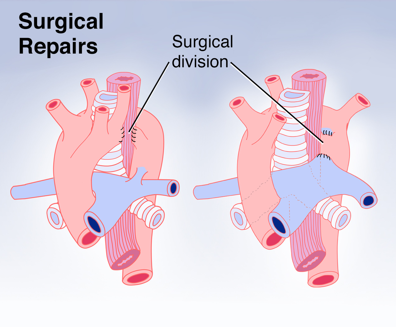 Aortic Arch Developmental Defects