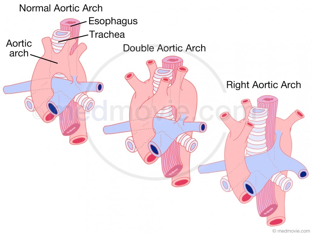 babies with interrupted aortic arch syndrome