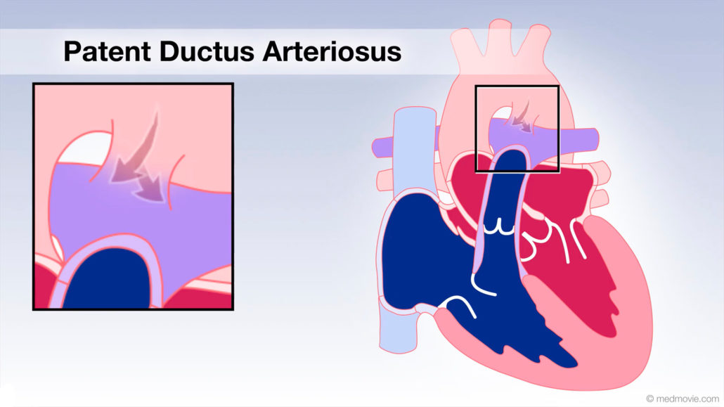 Ross Procedure