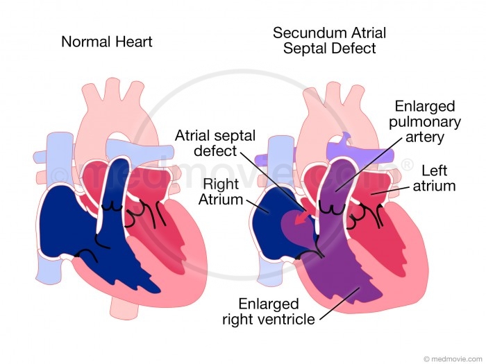 secundum-atrial-septal-defect-medmovie