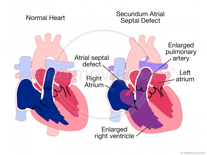 Secundum Atrial Septal Defect