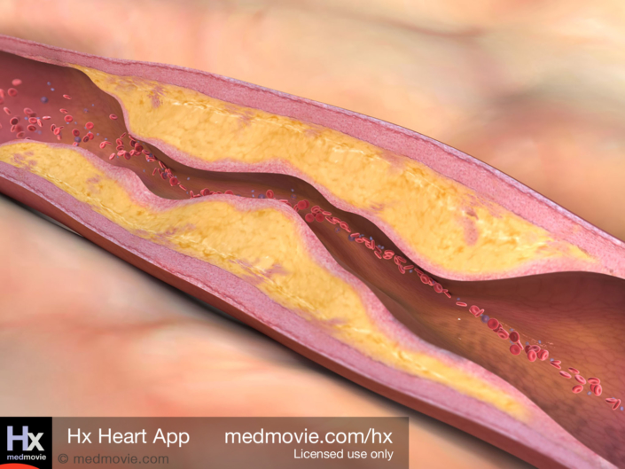 Severe Atherosclerosis