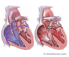 Balloon Atrial Septostomy (Rashkind) – Baby