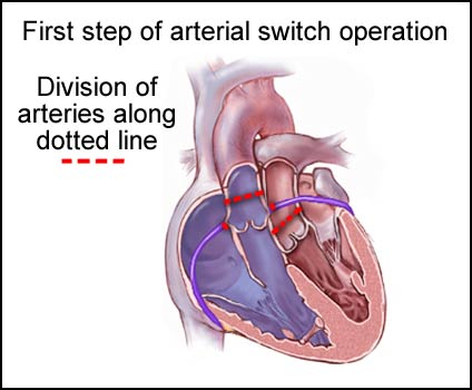 Arterial Switch Operation