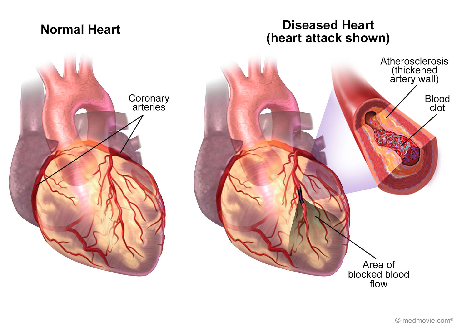 Ишемическая болезнь сердца снимок