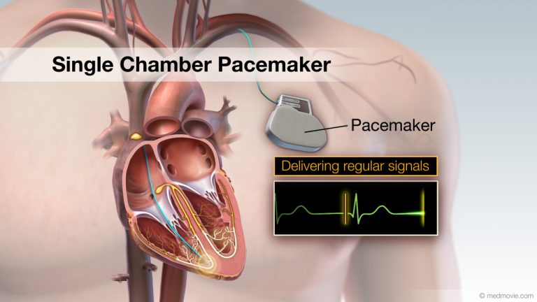 Pacemaker – Single Chamber