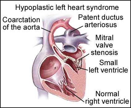 Norwood Procedure