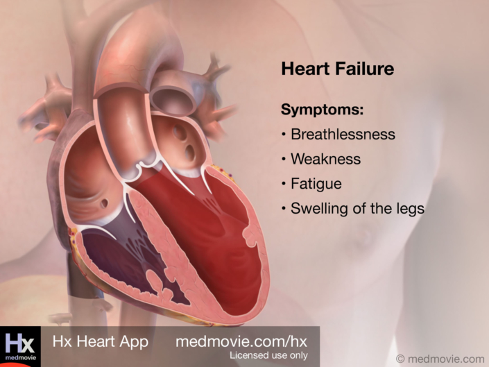 Heart Failure Symptoms