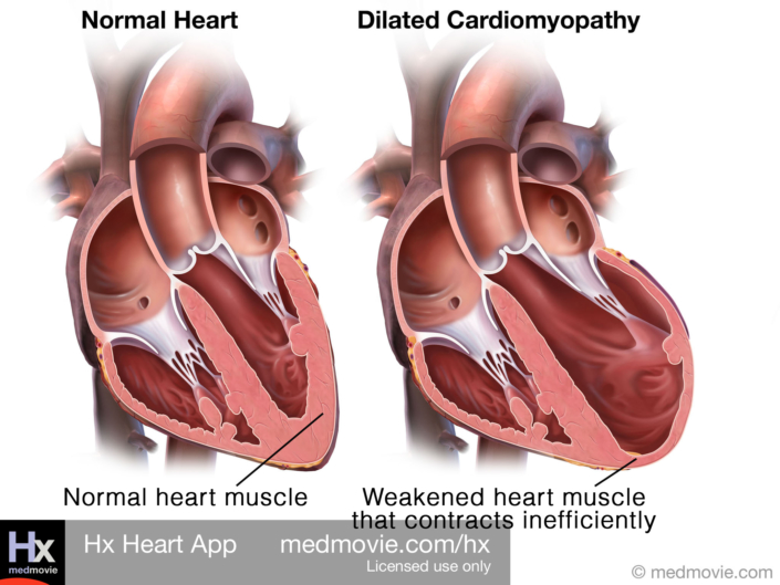 Atrial Fibrillation