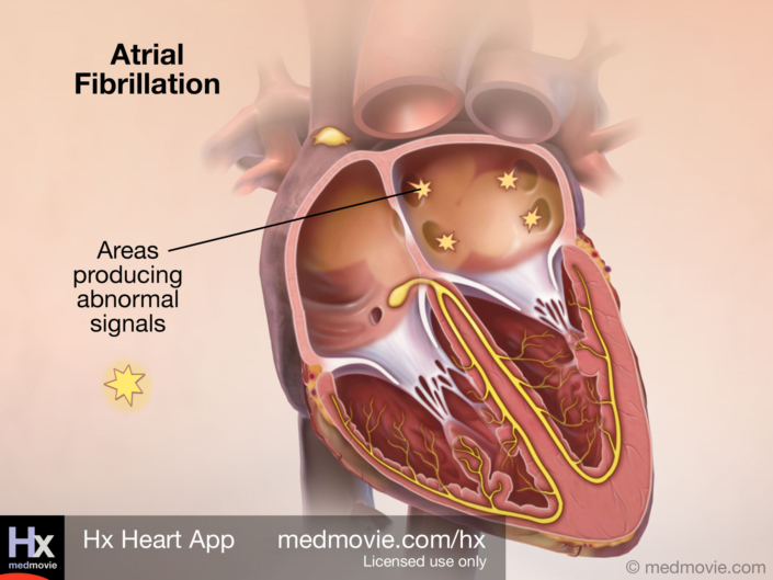 Atrial Fibrillation