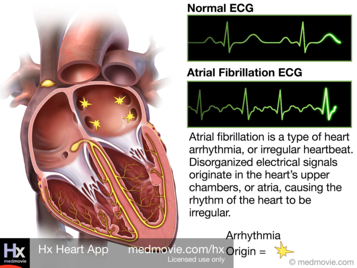 Atrial Fibrillation