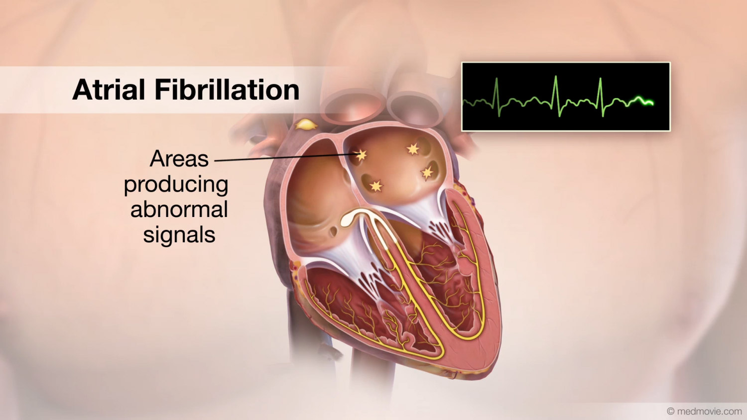 B3 afib. Atrial Fibrillation. Сердечная аритмия ЭКГ. Мерцательная аритмия фото. Atrial hypertrophy Heart