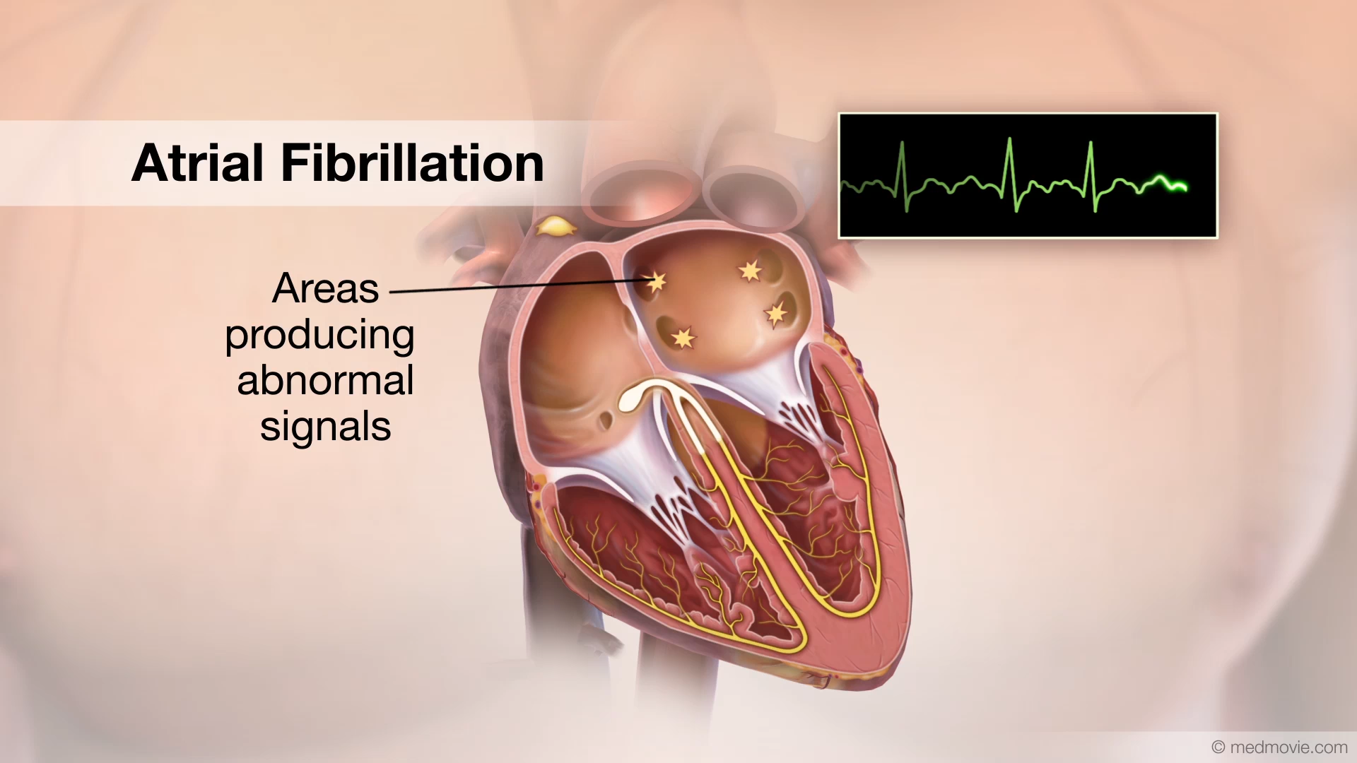 atrial fibrillation animation