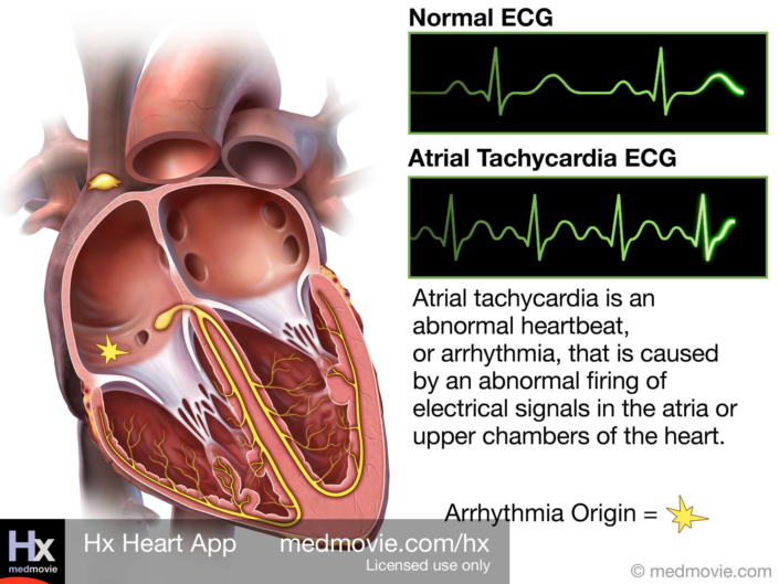 Atrial Tachycardia