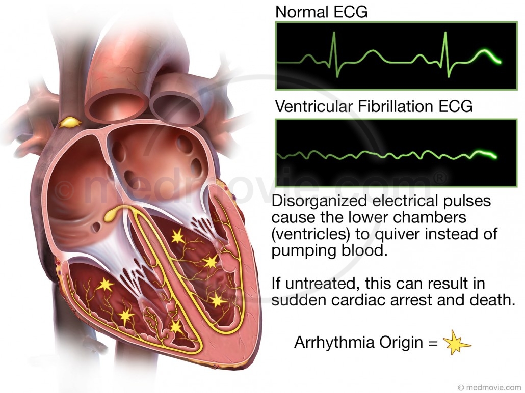 Ventricular Fibrillation