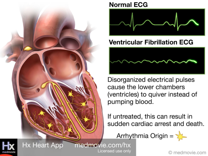 Ventricular Fibrillation