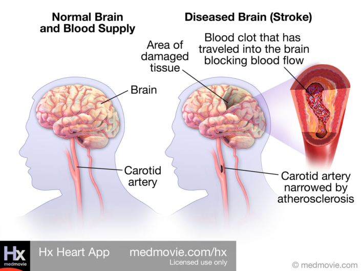 Normal Brain versus Brain with Stroke