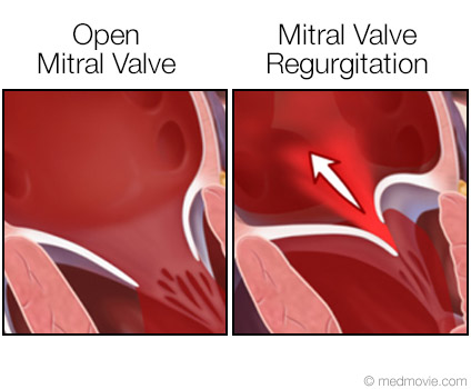 Mitral Valve Regurgitation